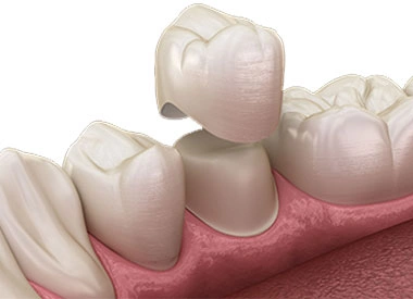 Dental crown fitting procedure