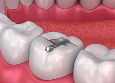 Close up of dental filling procedure