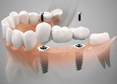 Digital dental implant scan on screen
