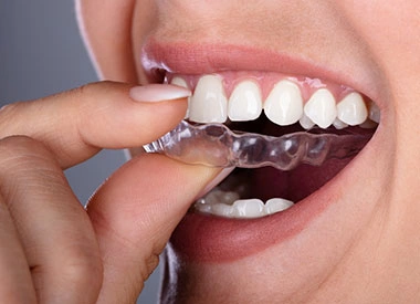 Clear invisible dental aligner