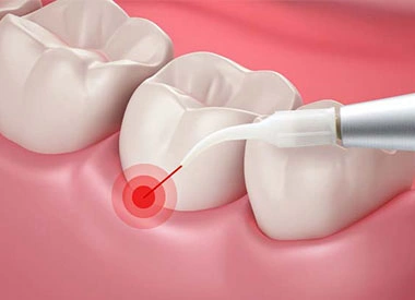 Laser scaling dental treatment