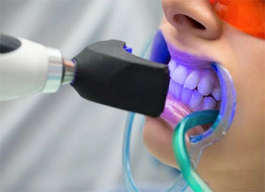 Teeth whitening treatment in progress