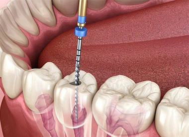 Dentist performing a root canal procedure